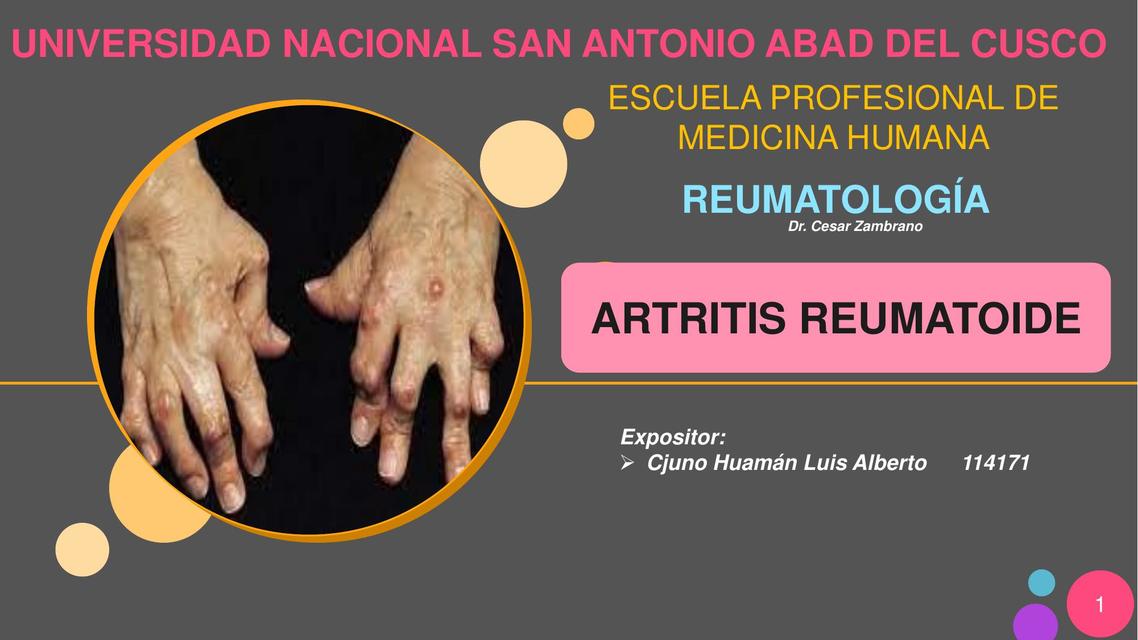 Artritis Reumatoide 