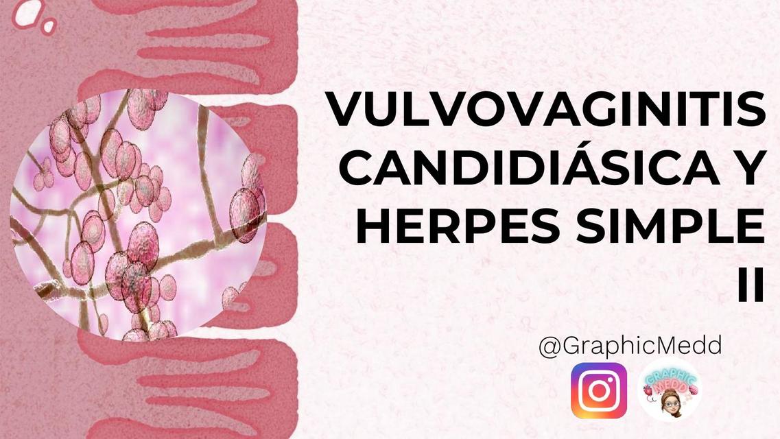 Vulvovaginitis Candidiásica y Herpes Simple