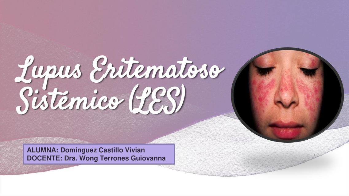 Lupus Eritematoso Sistémico