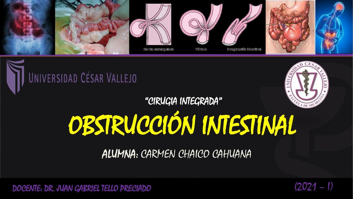 Obstrucción Intestinal