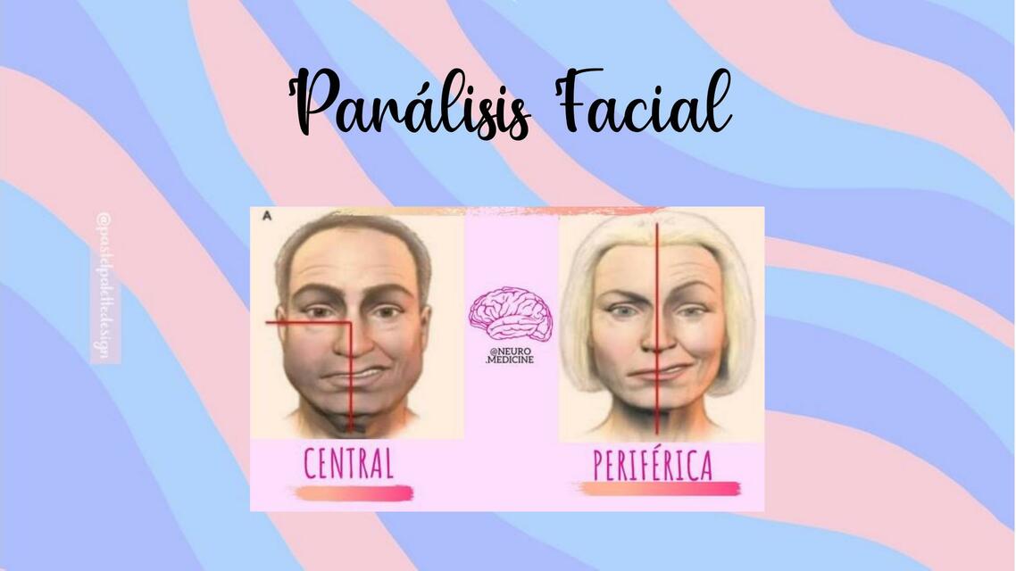 Parálisis Facial