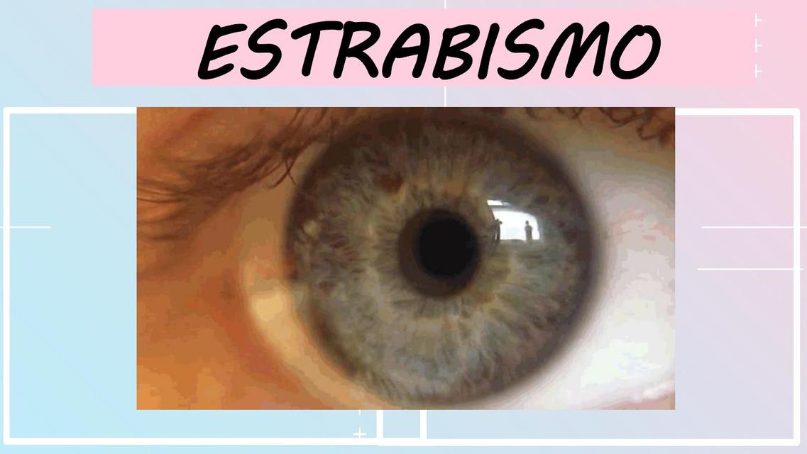 Estrabismo 