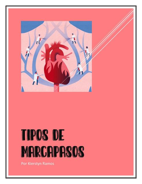 Tipos De Marcapasos