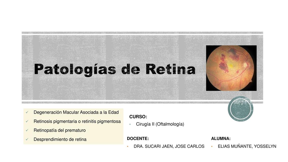 Patologías de Retina