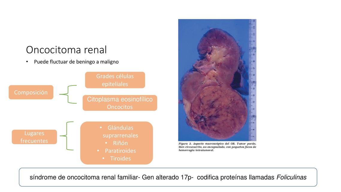 Oncocitoma renal