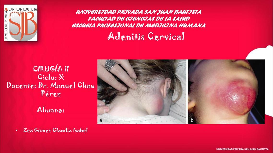 Adenitis Cervical 