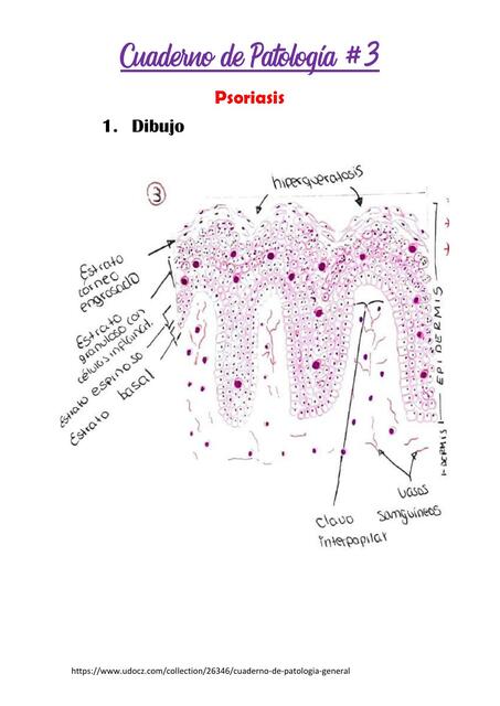 PSORIASIS Y ESOFAGO DE BARRET HISTOLOGIA