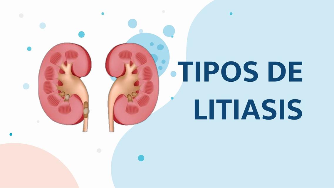 Tipos de Litiasis