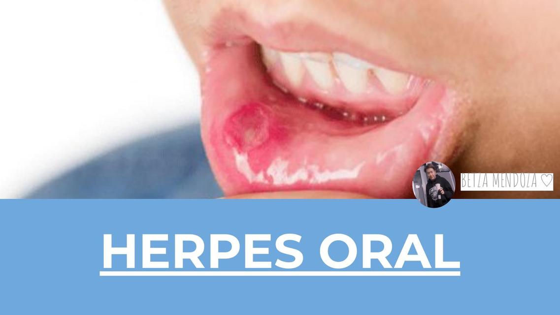 Herpes Oral