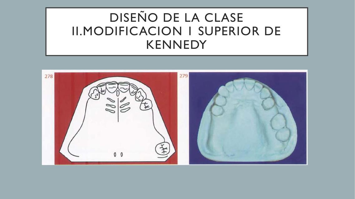 Confección de Prótesis Parcial Removible Clase II modificación I de Kennedy