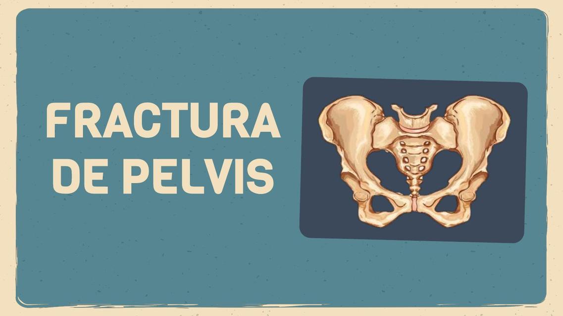 Fractura de Pelvis 