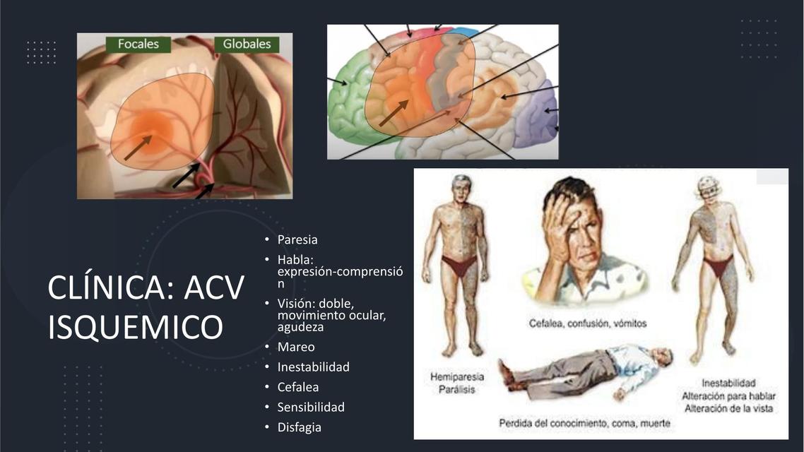 ACV Isquémico 