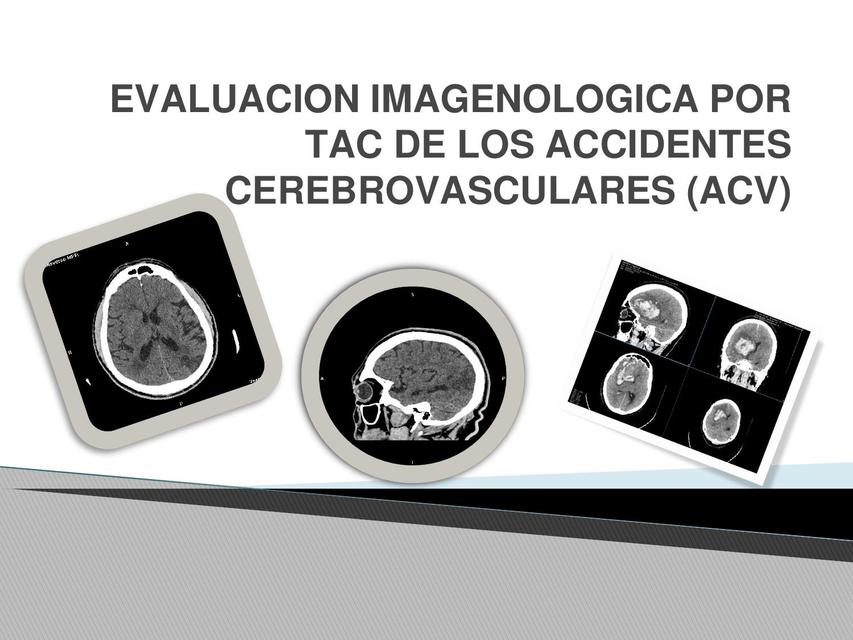 Interpretación Tc y Rm de Infartos Cerebrales y Aneurismas