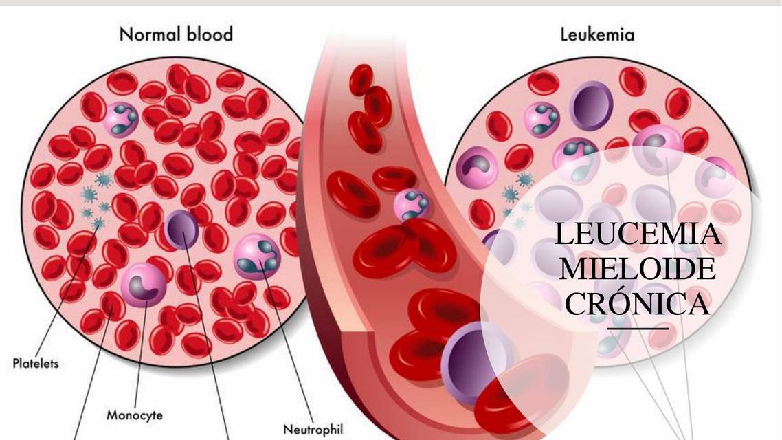 Leucemia Mieloide Crónica