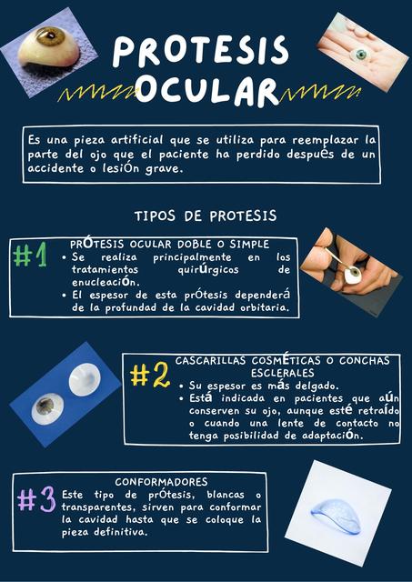 Prótesis Ocular