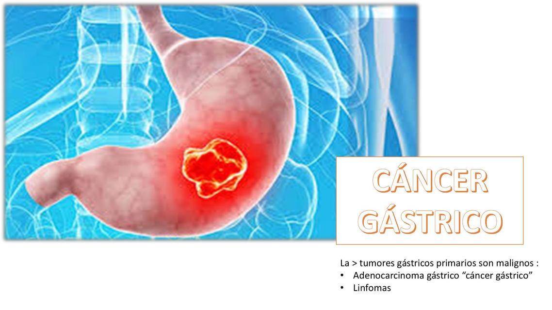 Cáncer Gástrico