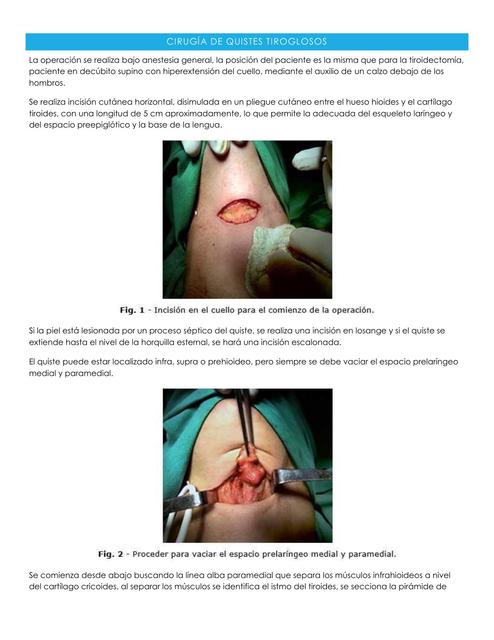 Cirugía de Quistes Tiroglosos 