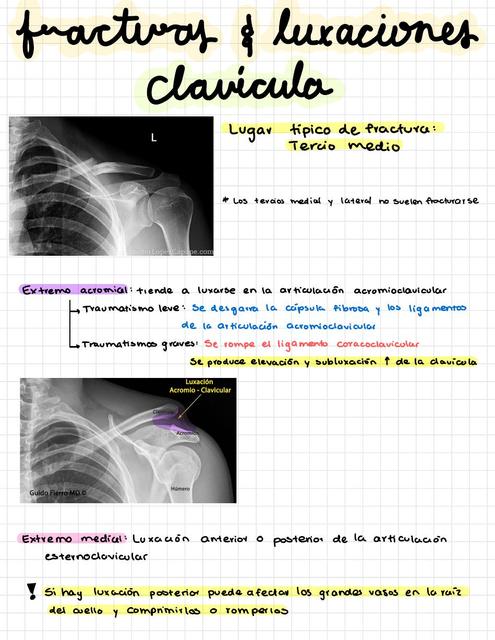 Fracturas y Luxaciones Clavícula