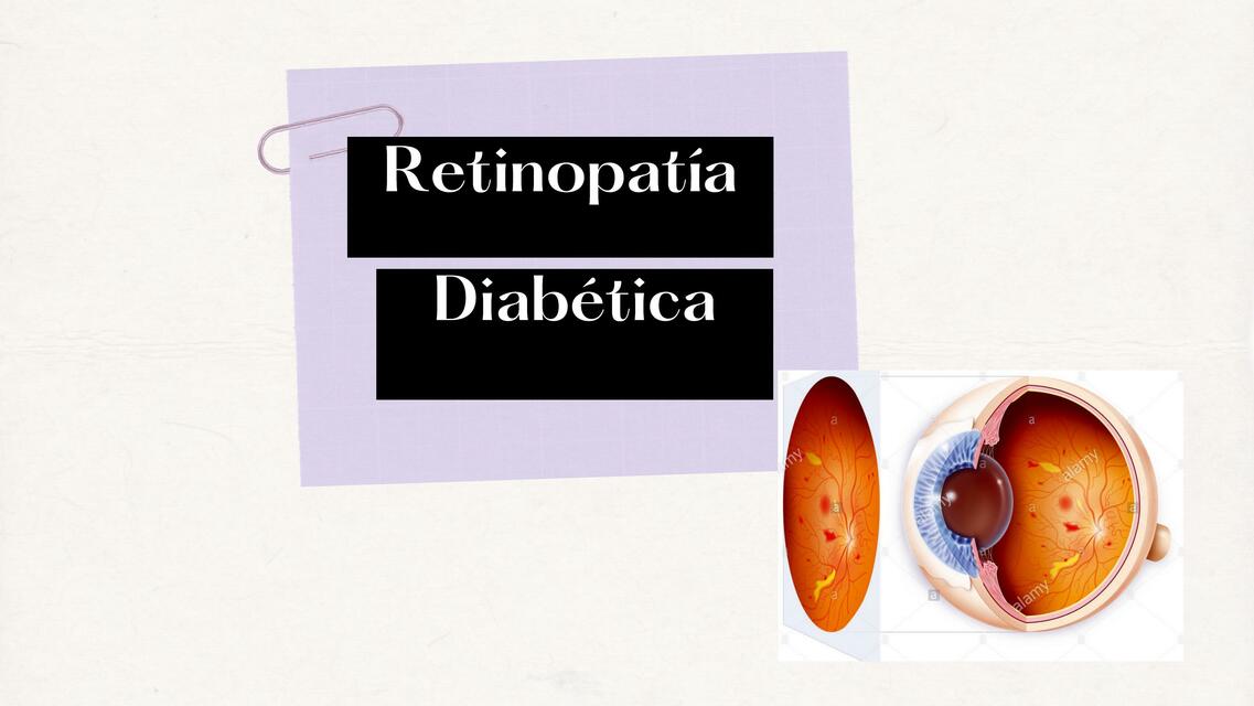 Retinopatía Diabética