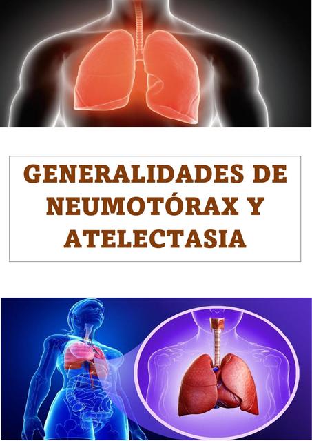 Generalidades de Neumotorax y Atelectasia