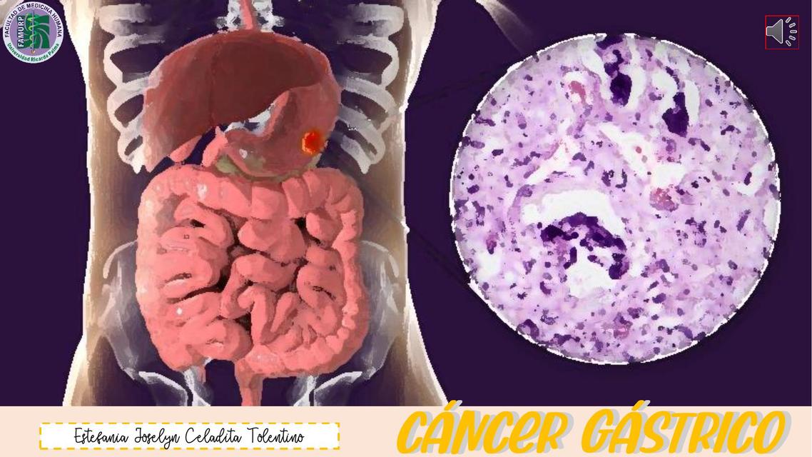 Cáncer Gástrico 