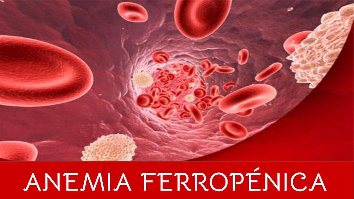 Anemia Ferropénica