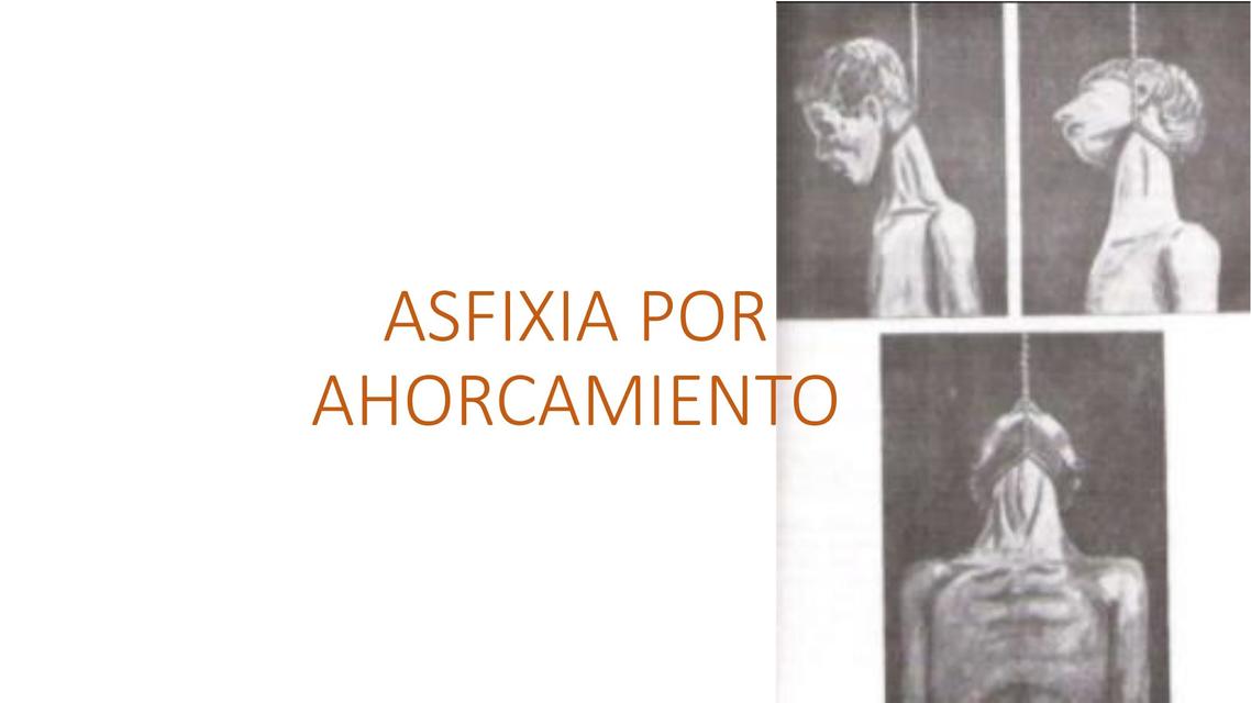 Asfixia por Ahorcamiento 