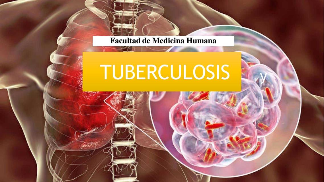 Tuberculosis