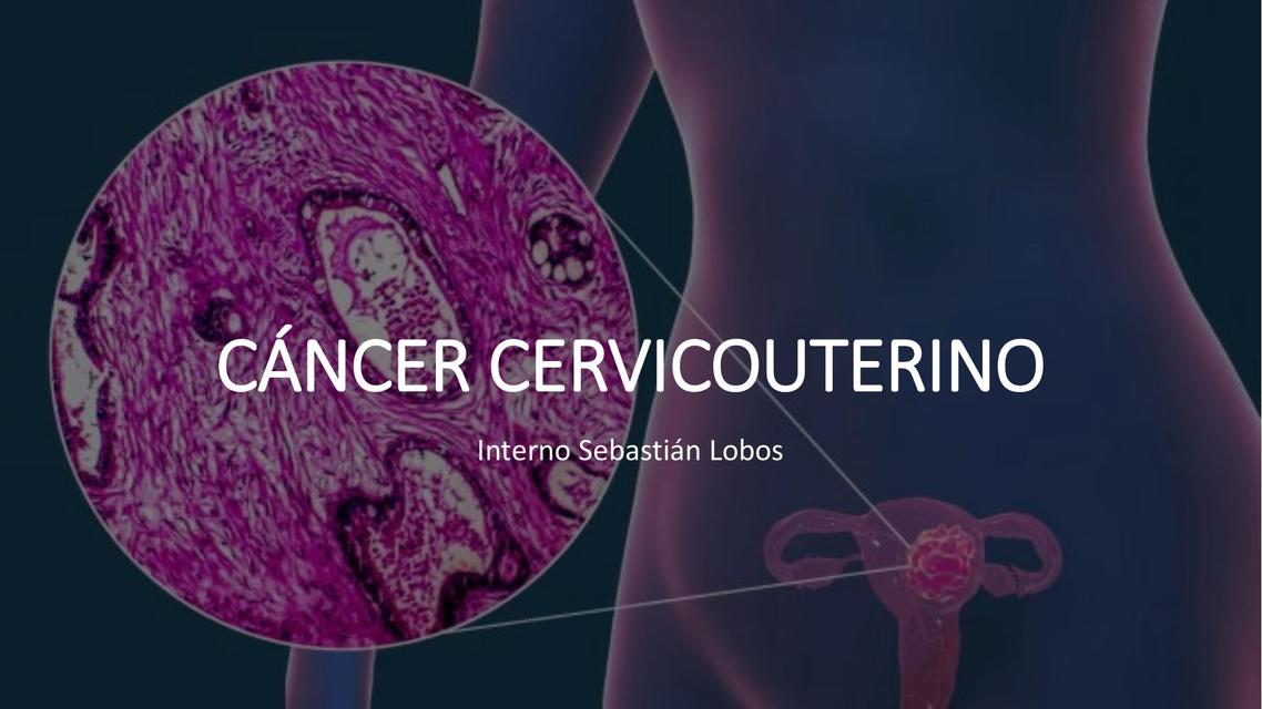 Cáncer Cervicouterino