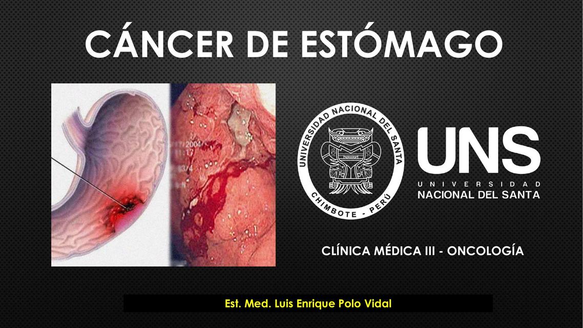 Cáncer de Estómago