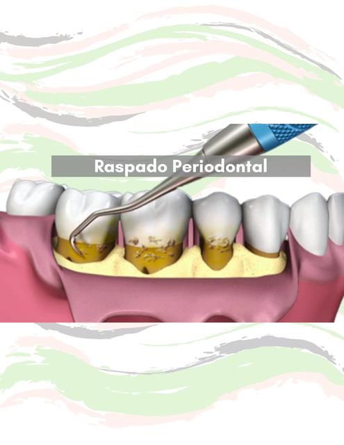 Raspado Periodontal