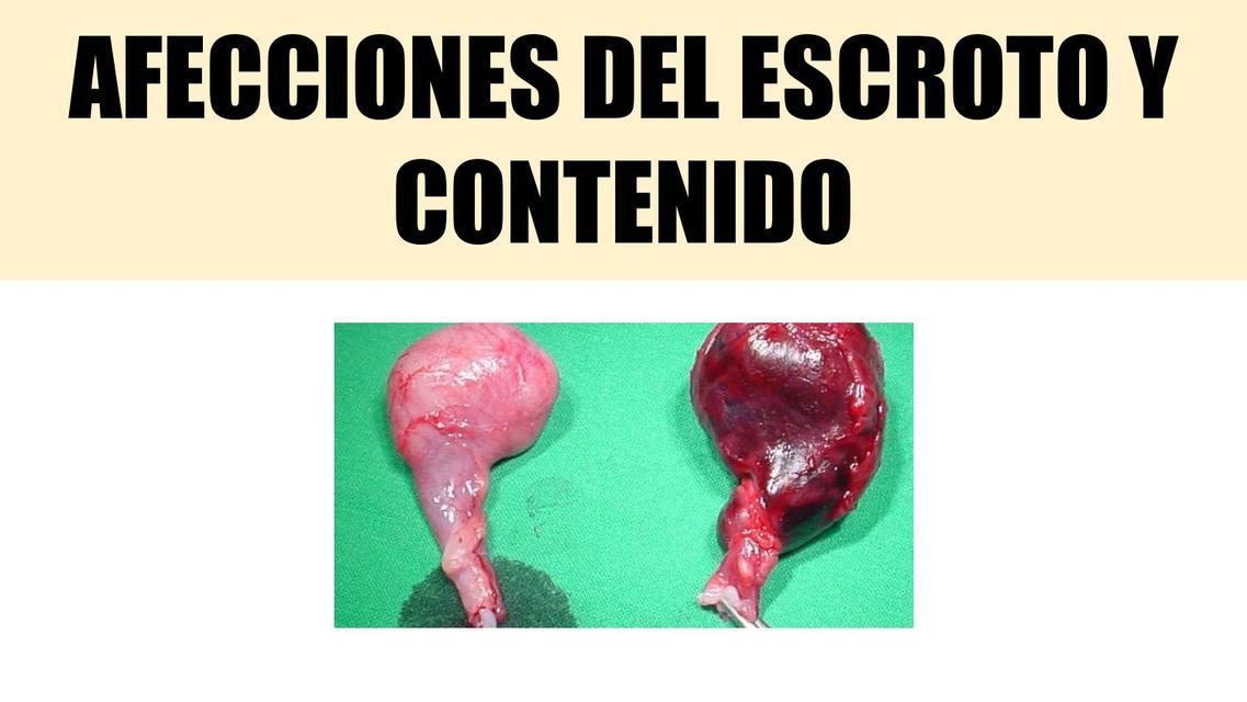 Afecciones del Escroto y Contenido 