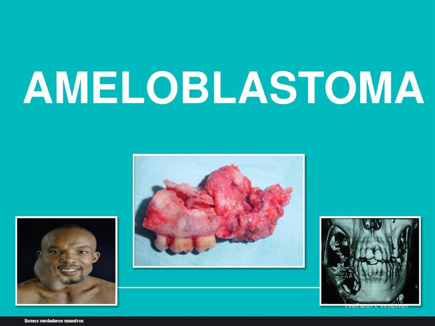 AMELOBLASTOMA