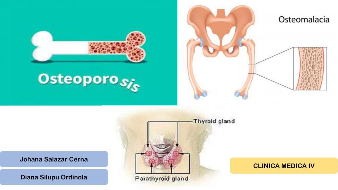 Osteoporosis 