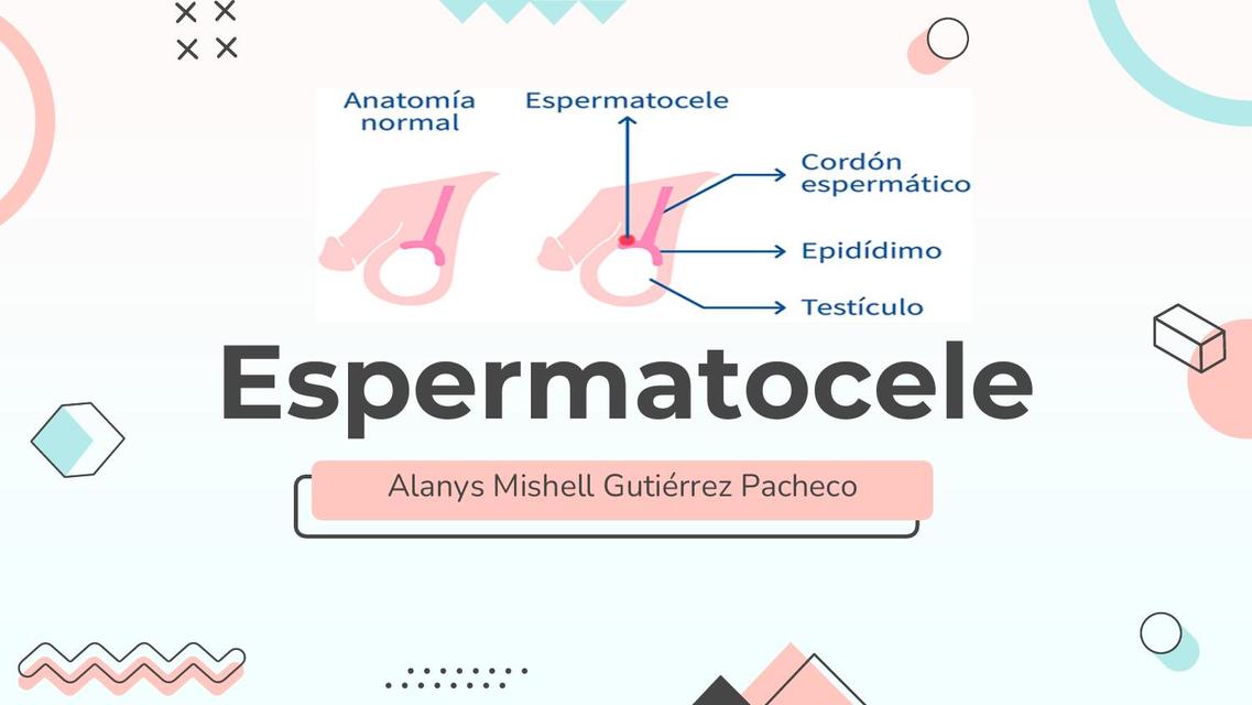 Espermatocele