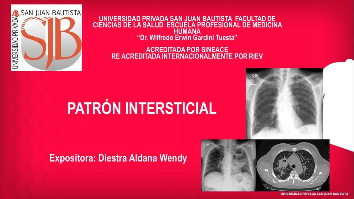 Patrón Intersticial