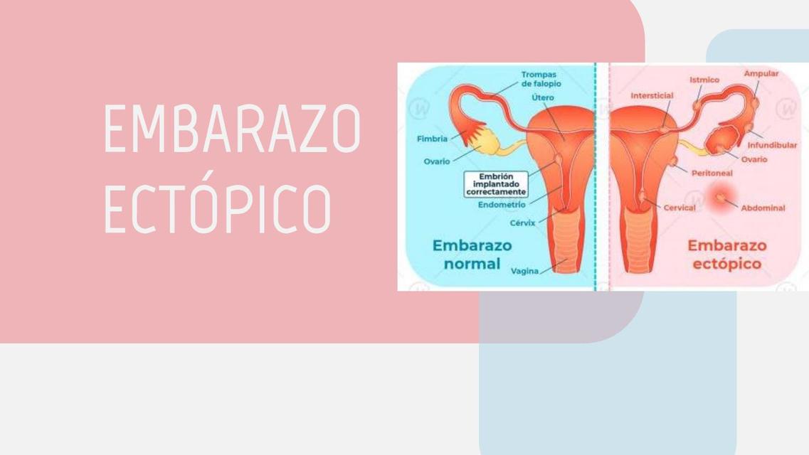 Embarazo Ectópico