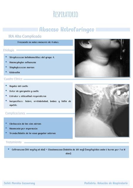 Absceso Retrofaríngeo