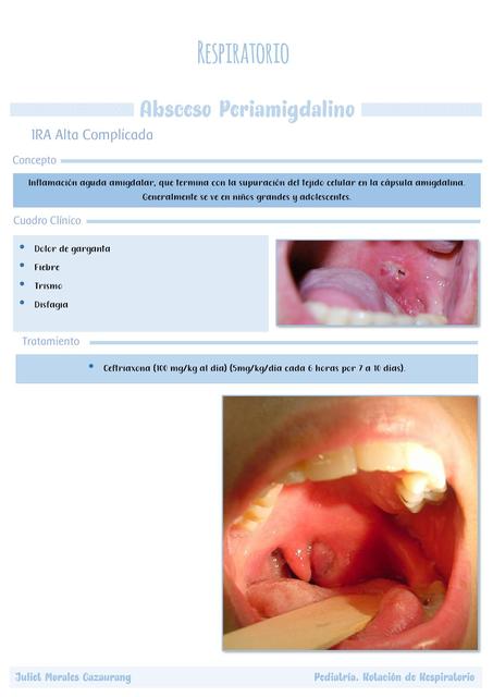 Absceso Periamigdalino