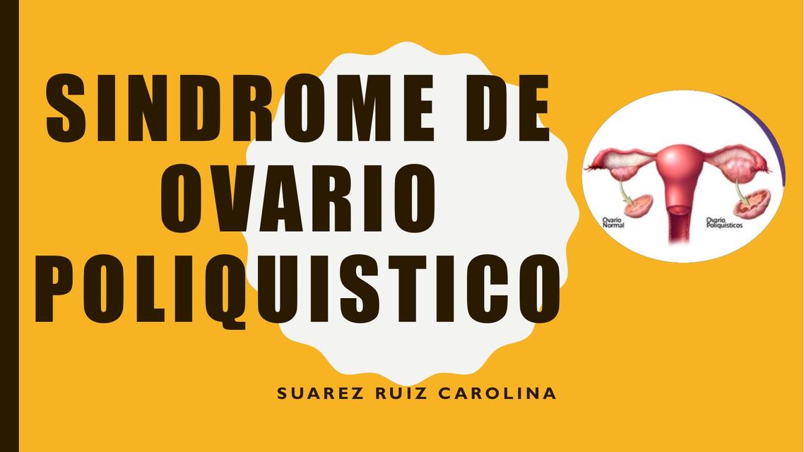 Síndrome de Ovario Poliquístico