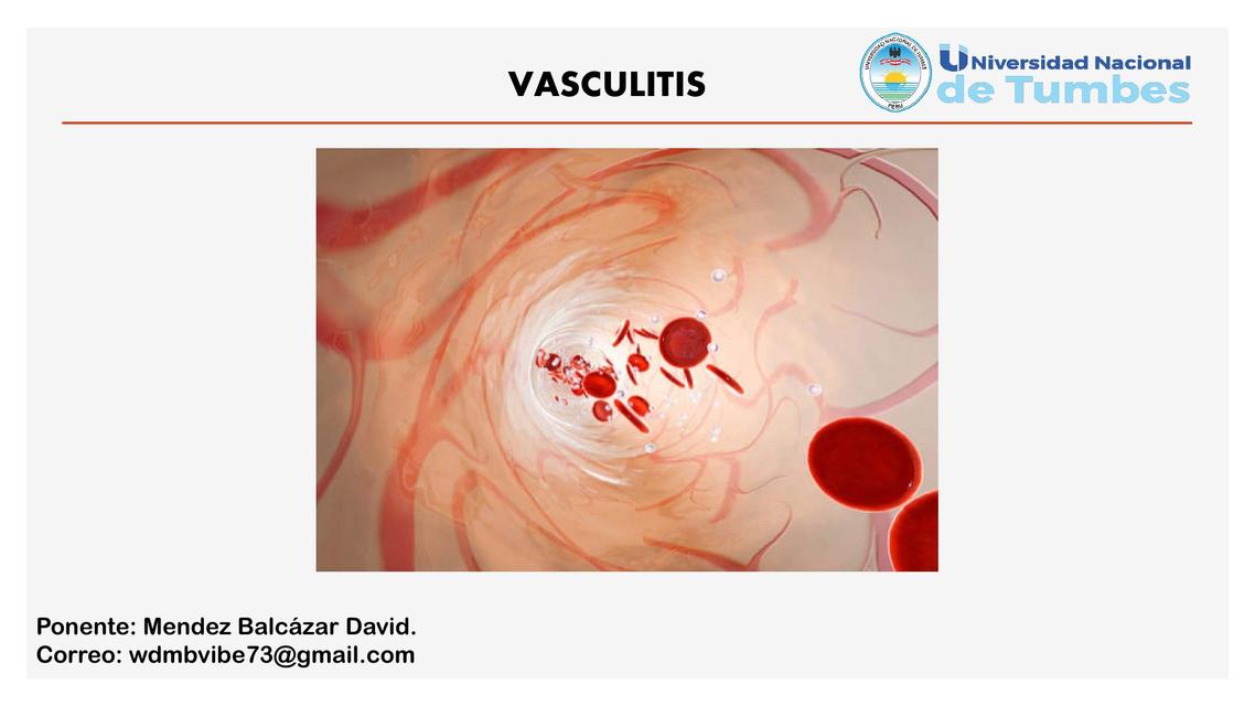 Vasculitis