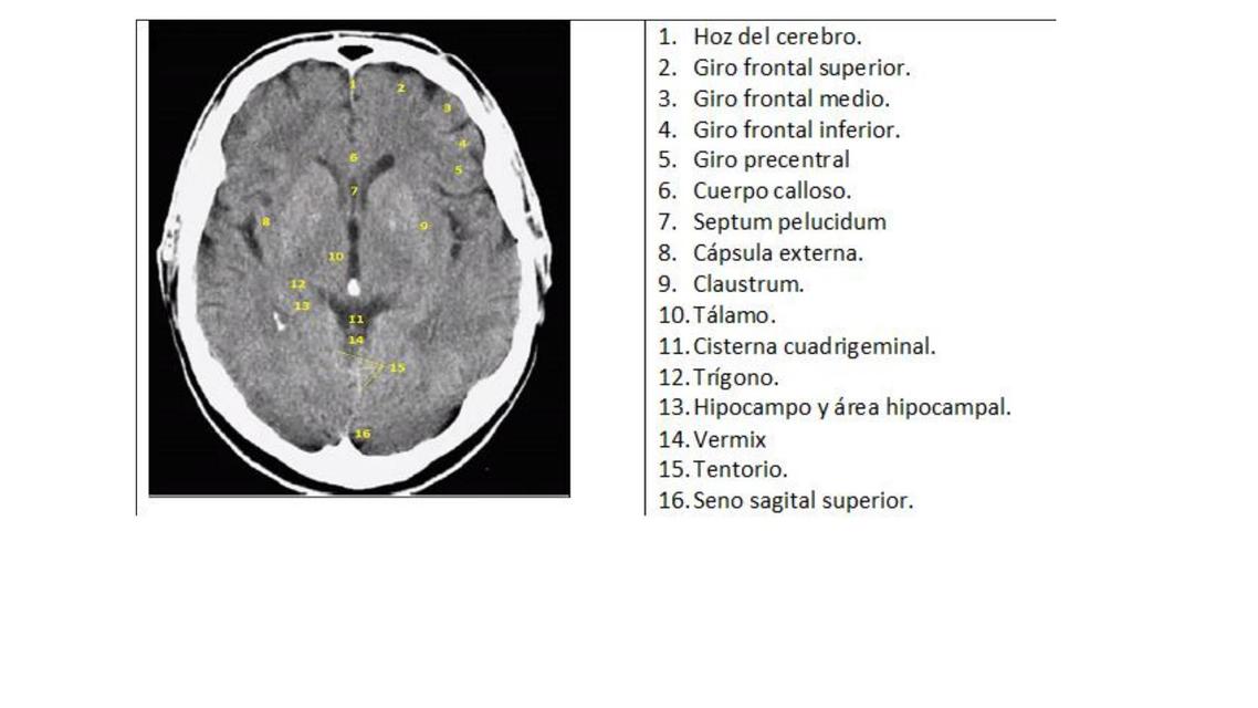 Hidrocefalia 