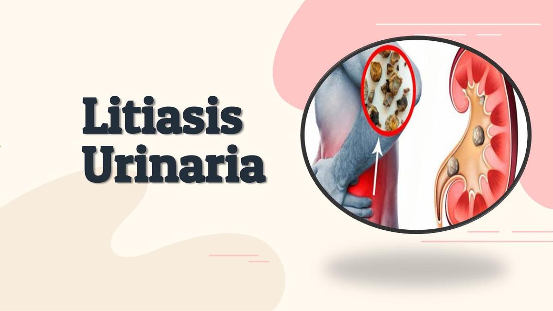 Litiasis Urinaria 