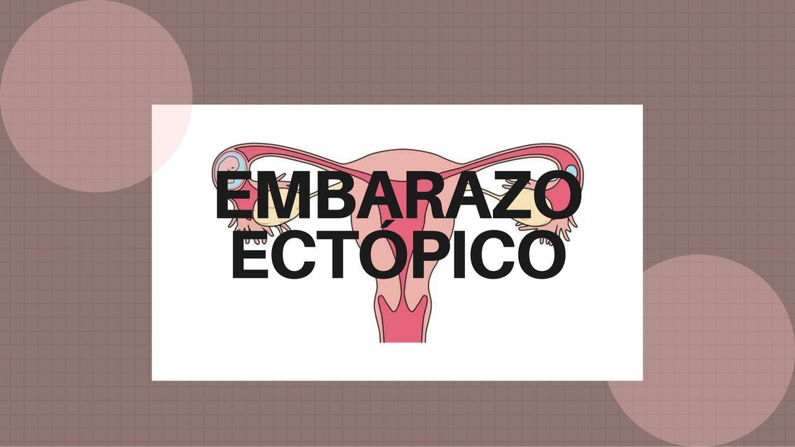 Resumen sobre embarazo ectópico