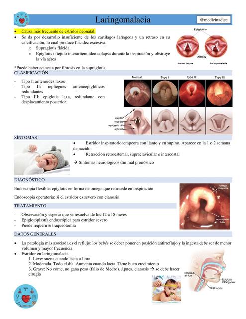 Laringomalacia