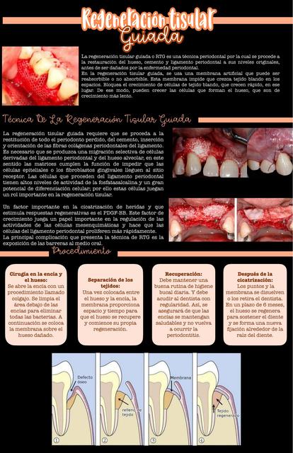 Regeneración Tisular Guiada