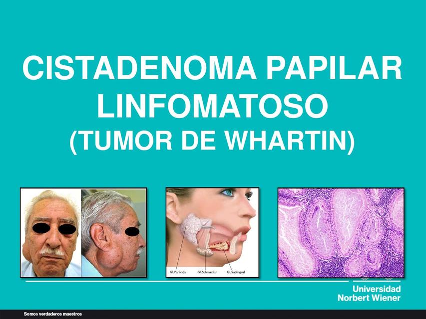 Tumor de Whartin. Cistadenoma papilar linfomatoso