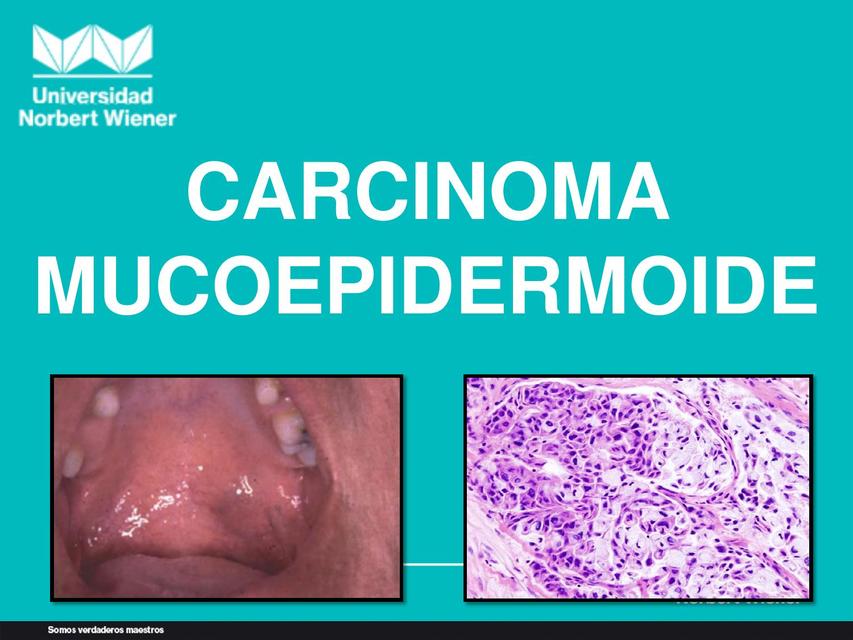 Carcinoma Mucoepidermoide