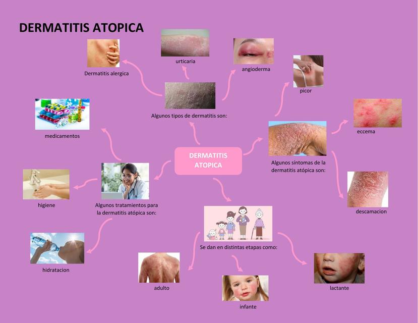 Derrmatitis Atópica