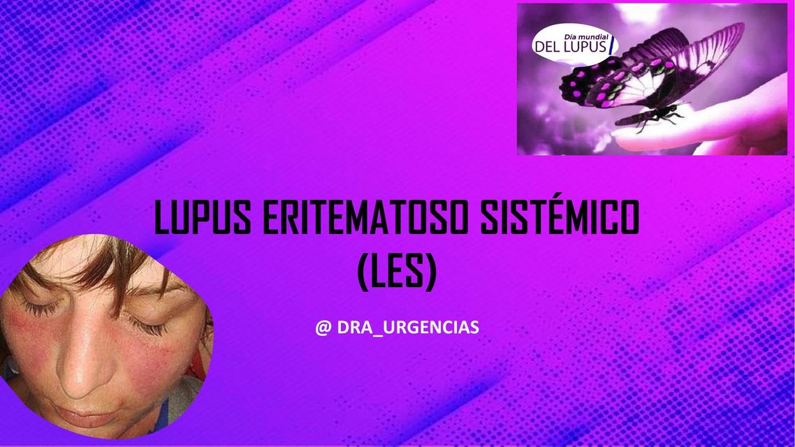 Lupus Eritematoso Sistémico 